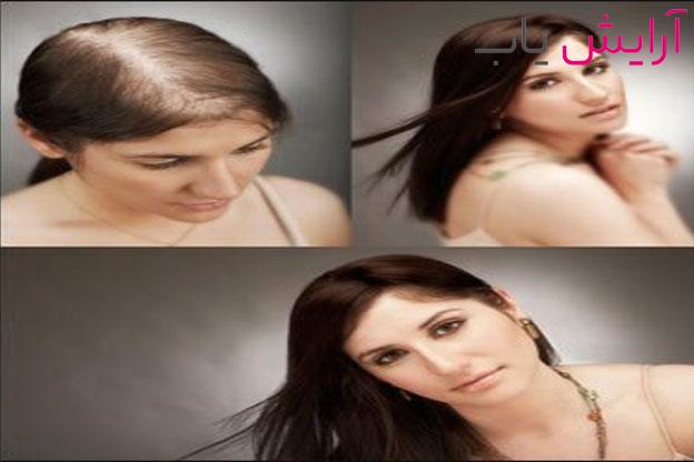 لوسیون ضد ریزش مو سینره