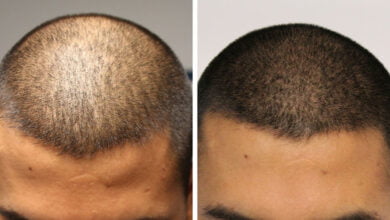 چند مزایا و معایب میکرواسکالپ که قبل از انجام آن باید بدانید