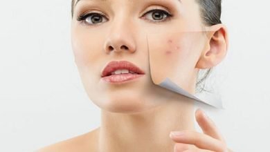 درمان جوش در خانه