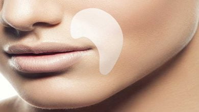 رفع خط خنده