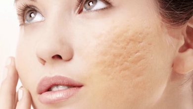 درمان جای جوش