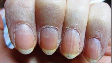 درمان خانگی ناخن های خشک