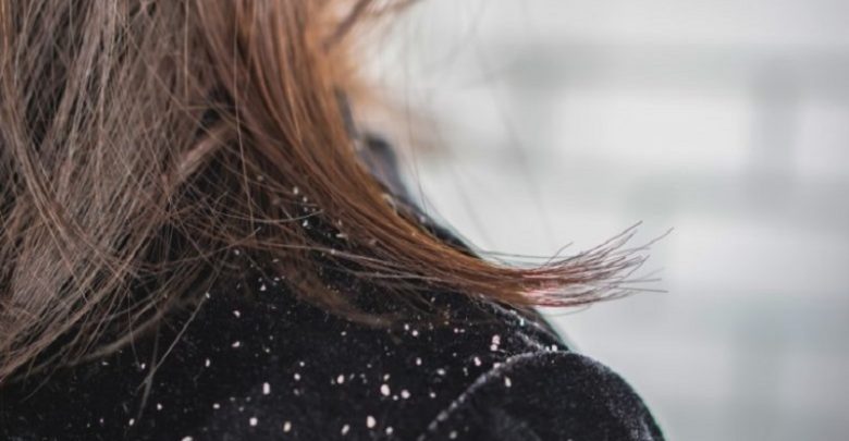 علت های ایجاد شوره سر