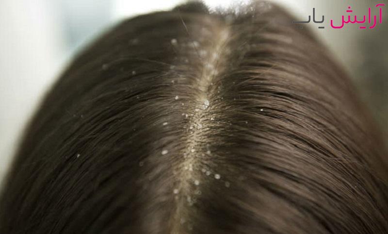 علت های شوره سر