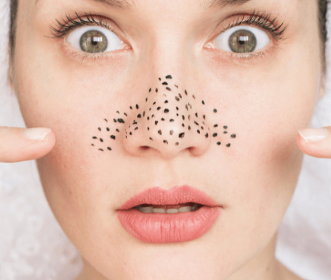 ساده ترین راه از بین بردن منافذ باز روی بینی